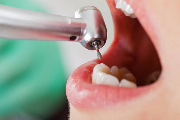Best Emergency Wisdom Teeth Removal in Morris, AL